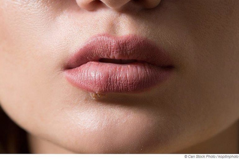 Can I go to a public sauna with cold sores?