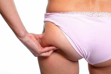 What is liposuction?